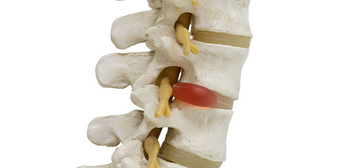 Herniated disc in spine before visiting San Ramon chiropractor