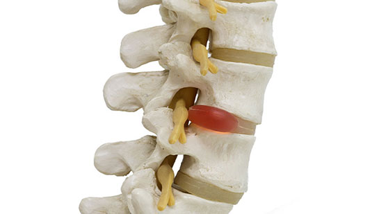 Herniated disc in spine before visiting San Ramon chiropractor