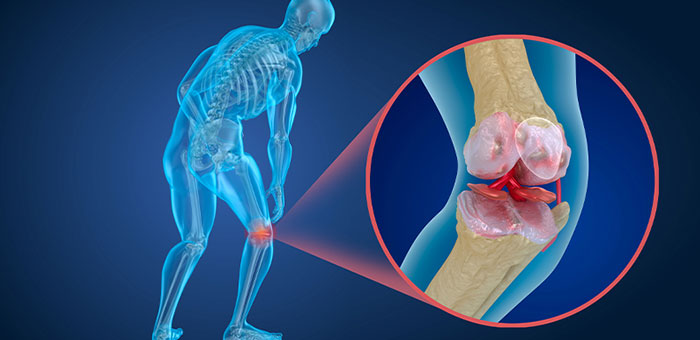 Osteoporosis pain in the knee before chiropractic treatment from San Ramon chiropractor