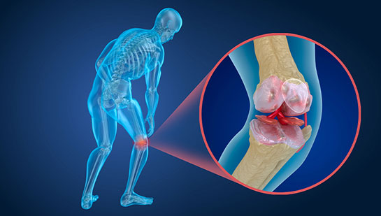 Osteoporosis pain in the knee before chiropractic treatment from San Ramon chiropractor