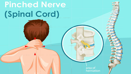 Pinched nerve in spine before chiropractic treatment from San Ramon chiropractor