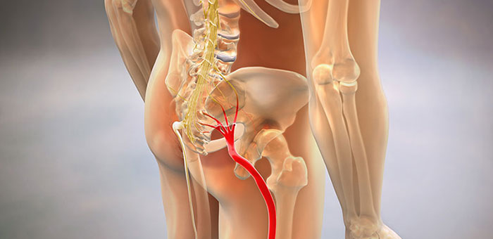Sciatic nerve pain before chiropractic treatment from San Ramon chiropractor