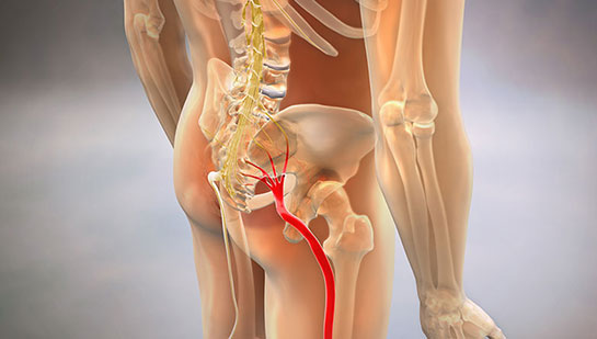 Sciatic nerve pain before chiropractic treatment from San Ramon chiropractor