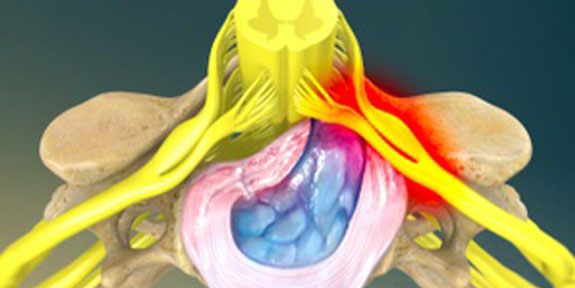 Herniated Disc San Ramon