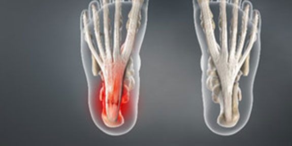 Plantar Fasciitis San Ramon