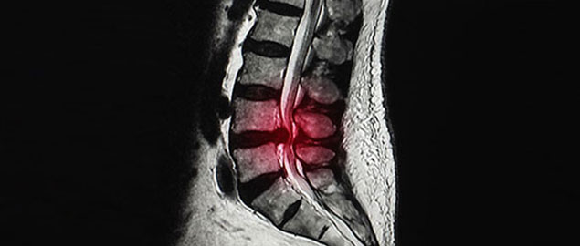 Xray of herniated disc San Ramon