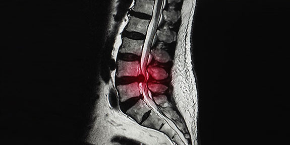 Disc Injury Treatment San Ramon